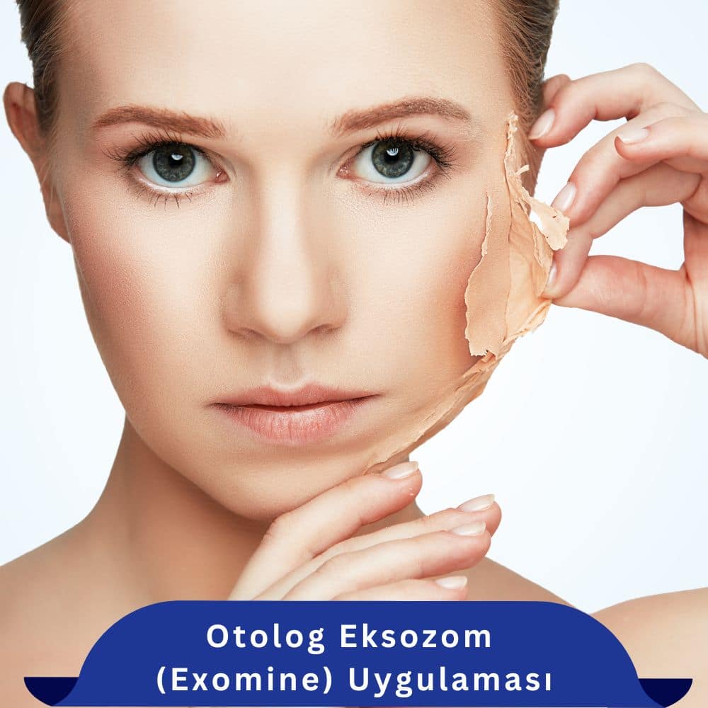 Otolog Eksozom denizli
