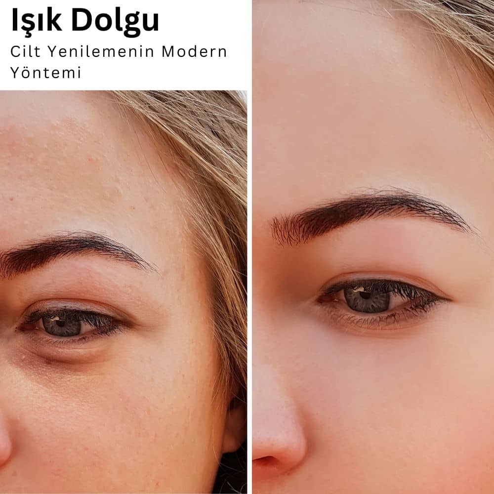 ışık Dolgu